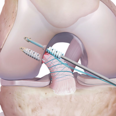 ACL-Refix-Schrauibe